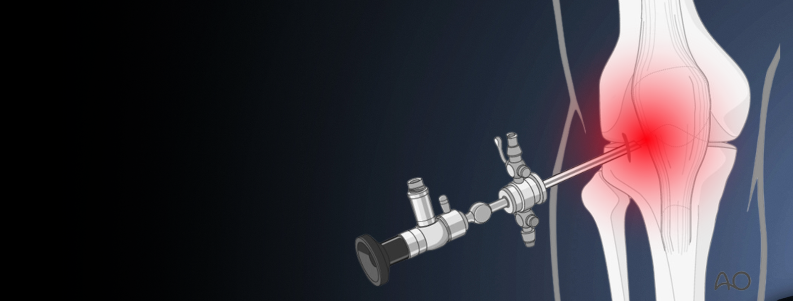 Dr. Bipin Solanki - Arthroscopic Surgery