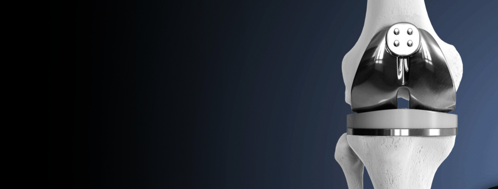 Dr. Bipin Solanki - Knee Replacement