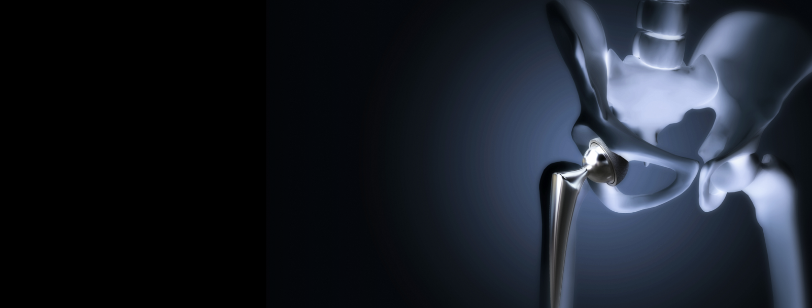 Dr. Bipin Solanki - Hip Replacement